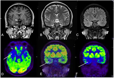 Utility of hybrid PET/MRI in stereoelectroencephalography guided radiofrequency thermocoagulation in MRI negative epilepsy patients